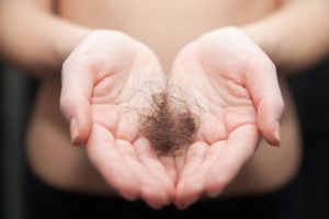 clumps of hair in a woman's hand due to hair loss